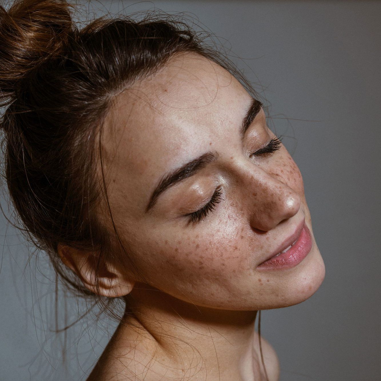 Acne Tagged "Acne" Bras Medical Spa