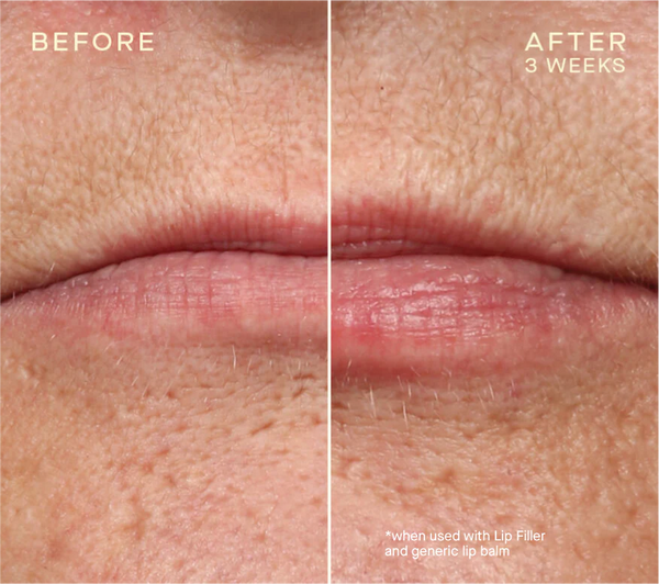 LIP FILLER REFILL